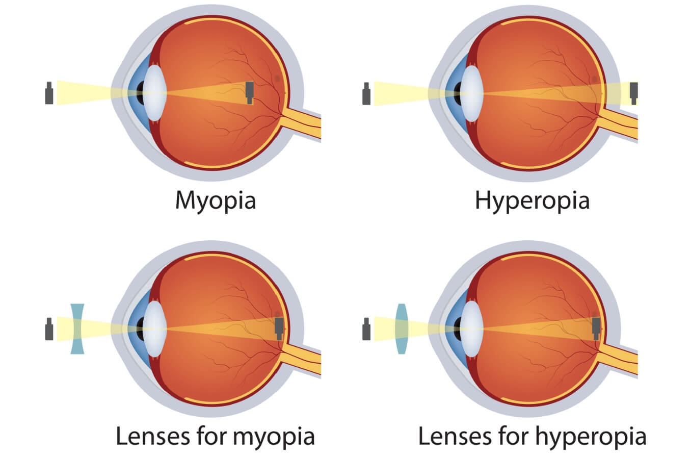 <p>Spectacles and contact lenses correct the vision of people with hyperopia, myopia and/or astigmatism by reflecting the light entering the eye in a way that is complementary to the defect in the eye.</p>