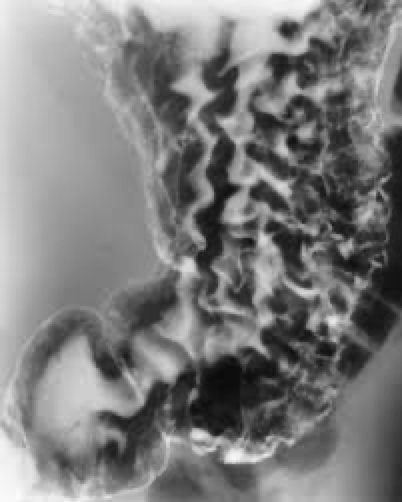 <p>Inflammation of lining</p>