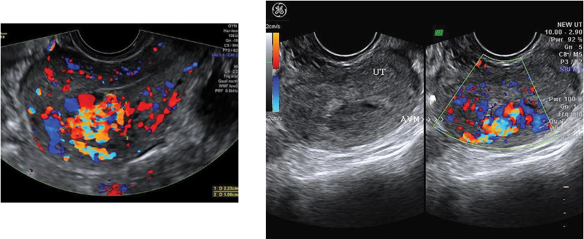 <p>-consist of vascular plexus of arteries and veins</p><p class="p1">without intervening capillary network.</p><p class="p1"> Rare; usually involving myometrium and rarely endometrium</p><p class="p1"> Congenital or teratogenic (acquired) due to pelvic trauma, surgery, or gestational</p><p class="p1">trophoblastic neoplasia</p><p class="p1"> Clinically, women of childbearing years have metrorrhagia with blood loss and anemia.</p><p class="p1"> Diagnosis critical because dilation and curettage may lead to catastrophic hemorrhaging</p><p class="p1">Sonographic findings</p><p class="p2"> Sonographically, <strong><em>serpiginous, anechoic structures seen within the pelvis</em></strong></p><p class="p2"> Uterine AVMs may appear as subtle myometrial inhomogeneity, tubular spaces within myometrium,</p><p class="p2">intramural uterine mass, endometrial or cervical mass</p><p class="p2"> <em>Color Doppler diagnostic to show blood flow within anechoic structures</em></p><p class="p1"> <em>May be </em><strong><em>florid-colored mosaic pattern </em></strong><em>with apparent flow reversals and</em></p><p class="p1"><em>areas of color aliasing</em></p><p class="p1"> <em>Spectral Doppler shows </em><strong><em>high-velocity, low-resistance arterial flow</em></strong></p><p class="p1"><em>coupled with high-velocity venous flow with arterial component</em>.</p>