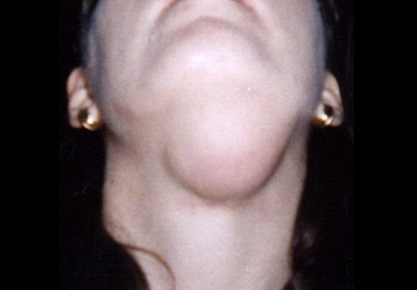 <p>Dissects through mylohyoid</p><p>▫ Swelling in the neck</p>