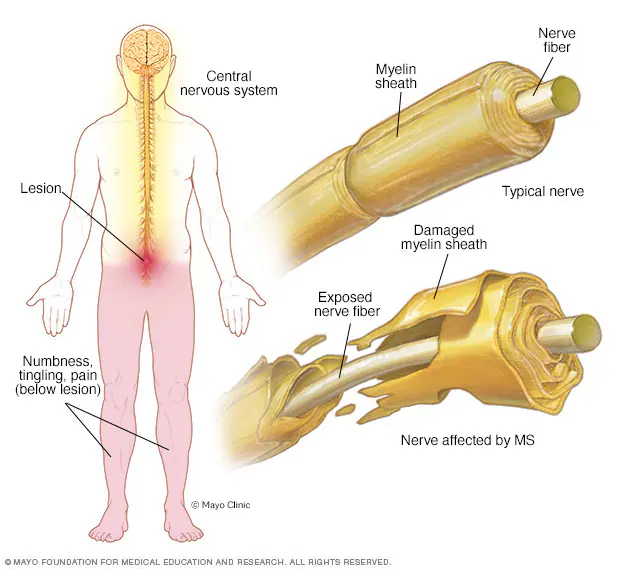 <p>Multiple sclerosis (MS).</p>