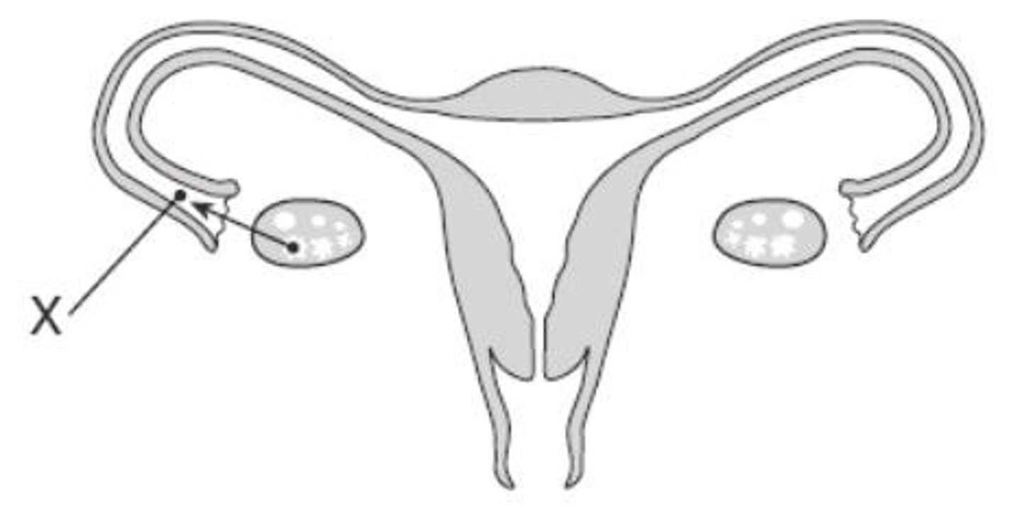 <p>The rupture of a mature follicle and release of an egg from the ovary</p>