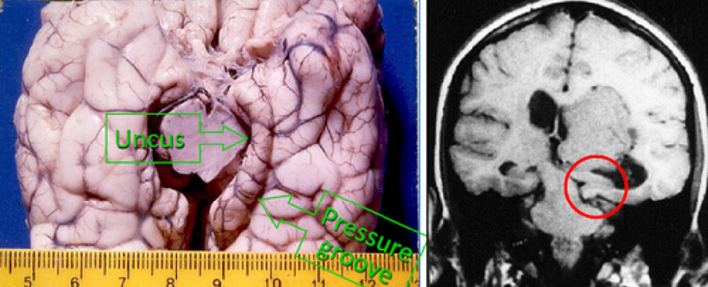<p>transtentorial herniation where the uncus of the temporal lobes is pushed downward onto the brainstem</p>