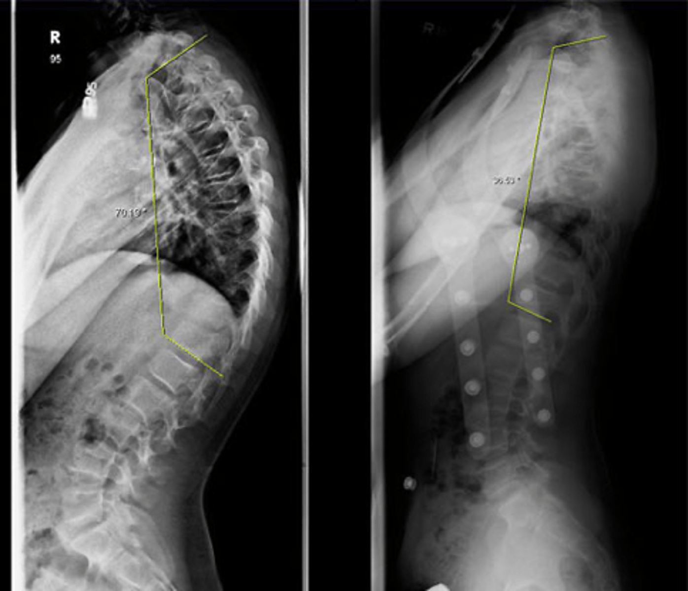 <p>Xray w/ AP &amp; Lateral view</p><p>Anterior wedging &amp; disc narrowing</p>