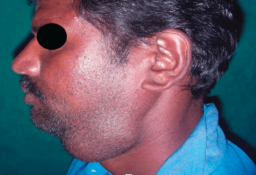 <ul><li><p>associated with <strong>stratified cuboidal epithelium</strong></p></li><li><p>a clinical condition resulting from the blockage of a duct, so saliva can not exit into the mouth</p></li><li><p>salivary stone <strong>(calculi)</strong>, which forms from salts in the saliva</p><ul><li><p>patient will feel pain when chewing food and swelling before mealtime</p></li></ul></li></ul><p></p>