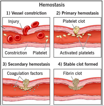 <ul><li><p><span style="background-color: transparent;"><span>Normal hemostatic response acts to arrest bleeding following injury to vascular tissue</span></span></p></li><li><p><span style="background-color: transparent;"><span>Four stages:</span></span></p></li></ul><ol><li><p><span style="background-color: transparent;"><span>Blood vessel constricts (smooth muscle) - helps reduce immediate blood loss</span></span></p></li><li><p><span style="background-color: transparent;"><span>Platelet clot - circulating platelets stick to damaged vessel and form a temporary platelet clot</span></span></p></li><li><p><span style="background-color: transparent;"><span>Coagulation cascade - coagulation factors amplify clotting effects to stabilize plug </span></span></p></li><li><p><span style="background-color: transparent;"><span>Fibrin clot - fibrin joins the party to form a solid, stable clot (during further healing, tissue replaces this)</span></span></p></li></ol><p></p>