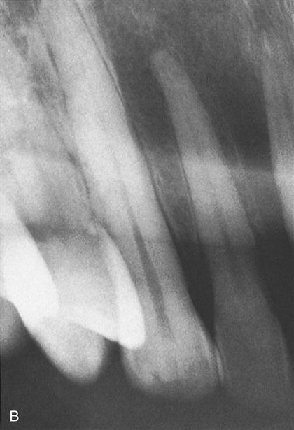 <p>Radiographic Error: Elongation</p>