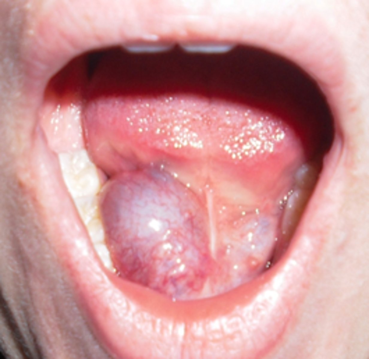 <p>mucocele of the floor of the mouth , usually associated with sublingual gland, floor of the mouth swelling. </p>