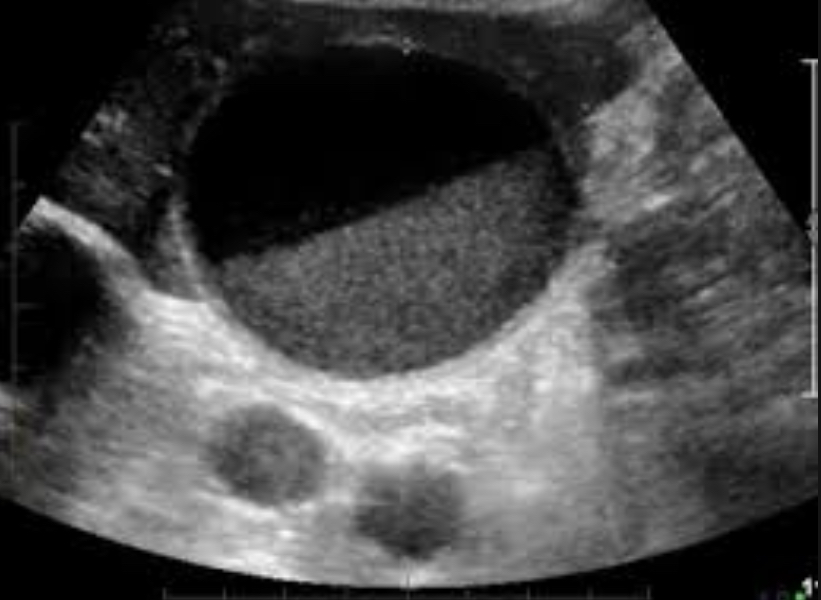 <p>Horizontal fluid-fluid level </p><p>Layered Echogenic line; shifts with patient position </p>
