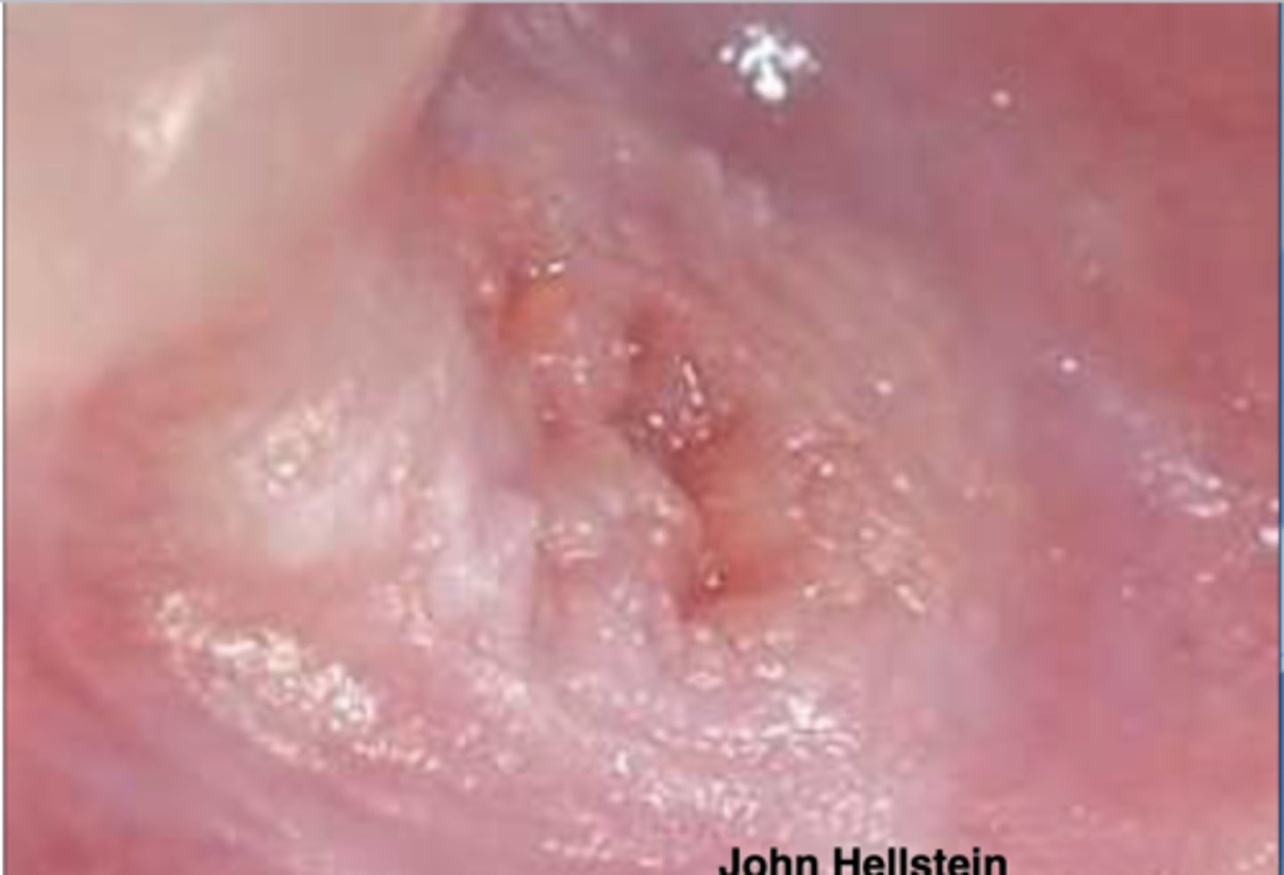 <p>Patient presents with this wart-like lesion on a portion of their oral mucosa. HPV has been ruled out. What do you suspect?</p>
