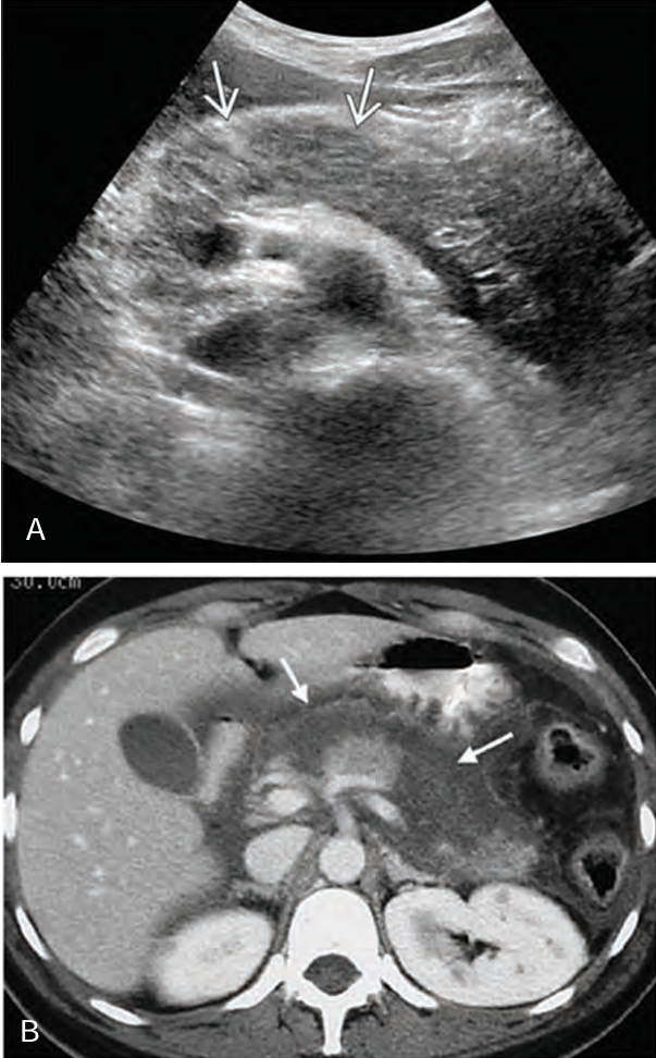 <p>Pancreatic enzymes cause focal areas of fat ______, _____ and ______ the pancreas, which leads to _____ of pancreatic ______ and _______</p>