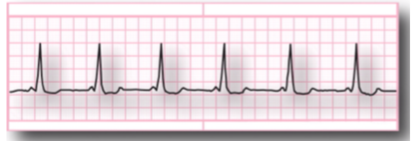 <p>characteristics of  Wolff-parkinson-White (WPW)?</p>