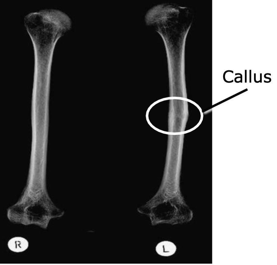 1. If injured, cells tend to overgrow at an injury site
2. Forms a bony callus from the overgrowth of the osteoblasts 