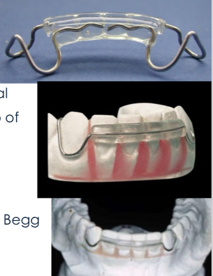 <p>Clip on/spring retainer</p><p>Runs labial and lingual </p><p>Wrap around retainer is an extended version- covers all teeth </p>