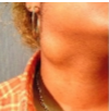 <p>swelling in upper part of neck to SCM muscle, </p><p>± fistula to surface</p>