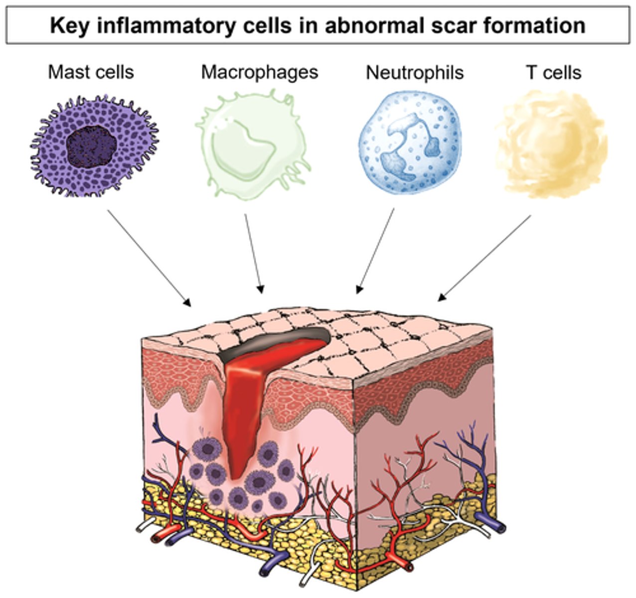 <p>- d/t repetitive inflammation</p><p>- causes dysfunction of the affected part of the body</p><p>- results in proliferation &amp; therefore scarring d/t constant overwhelming response</p>