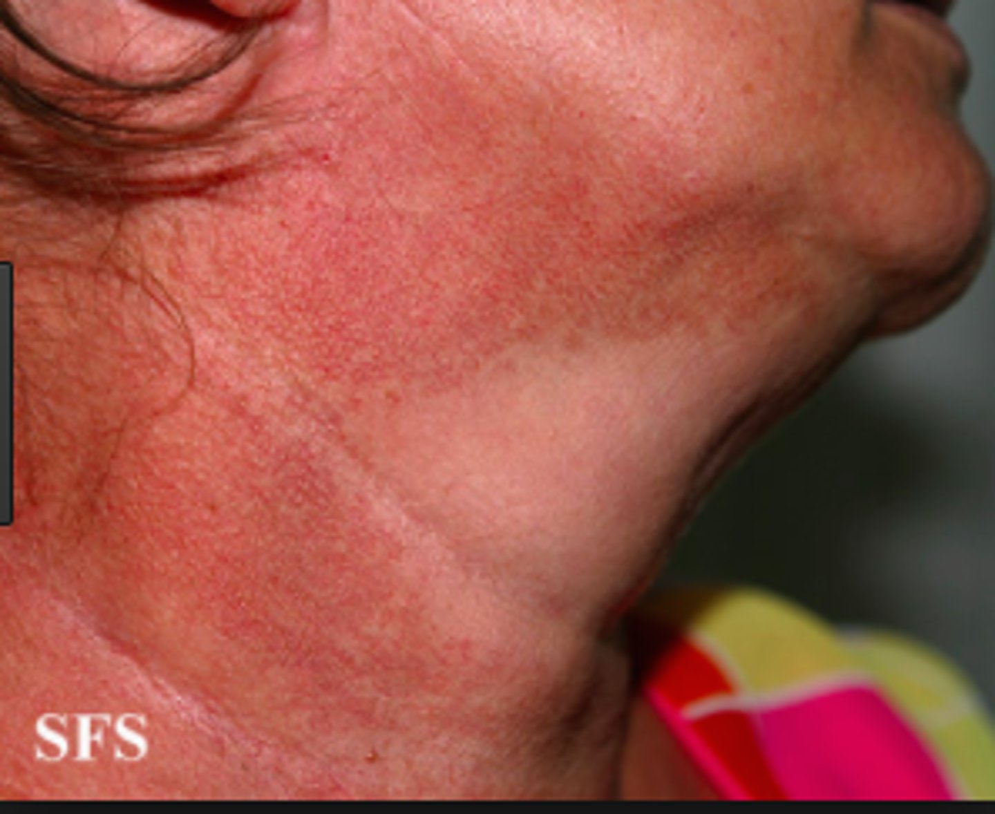 <p>skin condition caused by actinic bronzing to the sides of face &amp; neck</p>