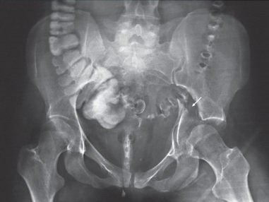 <ul><li><p>structures shown:</p><ul><li><p>pelvis with both hip bones</p></li><li><p>sacrum and coccyx</p></li><li><p>proximal femora including head, neck, and trochanters</p></li></ul></li><li><p>evaluation criteria:</p><ul><li><p>entire pelvis, including proximal femora and hip bones</p></li><li><p>no rotation</p><ul><li><p>symmetric appearance of iliac wings and obturator foramina</p></li><li><p>femoral necks no foreshortened</p></li><li><p>greater trochanters in profile</p></li></ul></li></ul></li></ul><p></p>