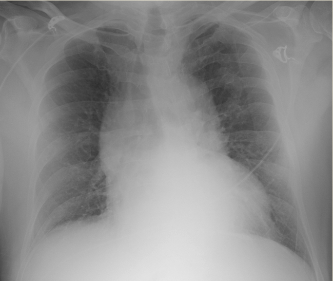 <p>sudden onset of chest &amp; neck pain prior to syncopal episode</p><p>dx?</p>