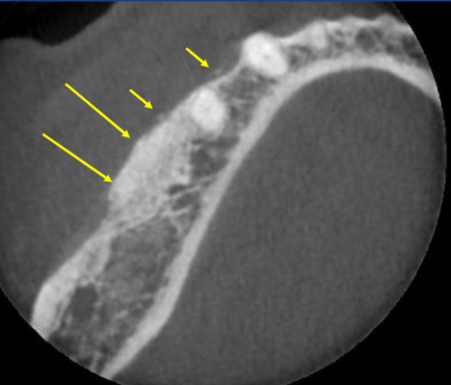 <ul><li><p>granular, RO material </p></li><li><p>edentulous site </p></li><li><p>within sockets, along alveolar ridge </p></li><li><p>sinus floors </p></li><li><p>loose fragments within soft tissue </p></li></ul><p></p>