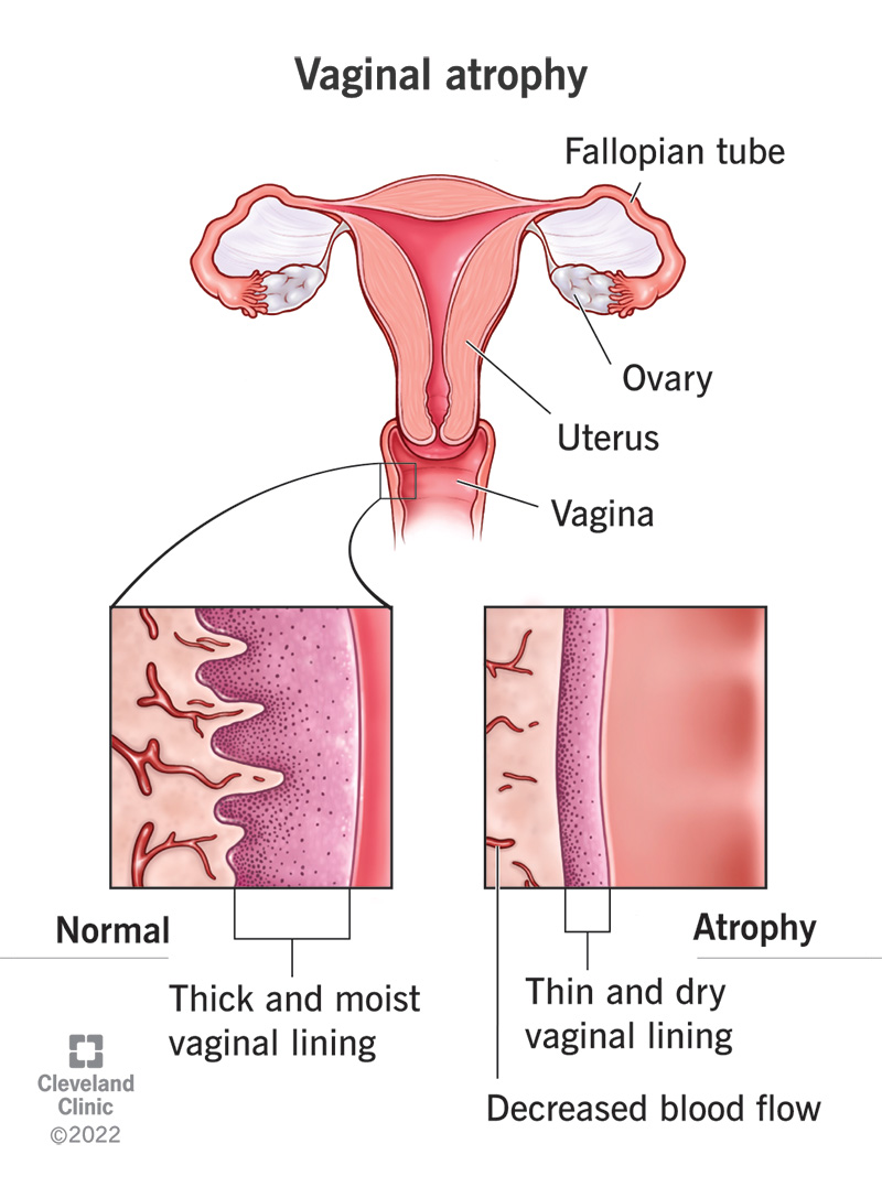<p>shrinkage of the vaginal size &amp; decrease in lubrication </p>