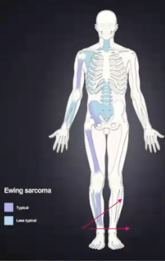 <p>Where would you find ewing sarcoma?</p>