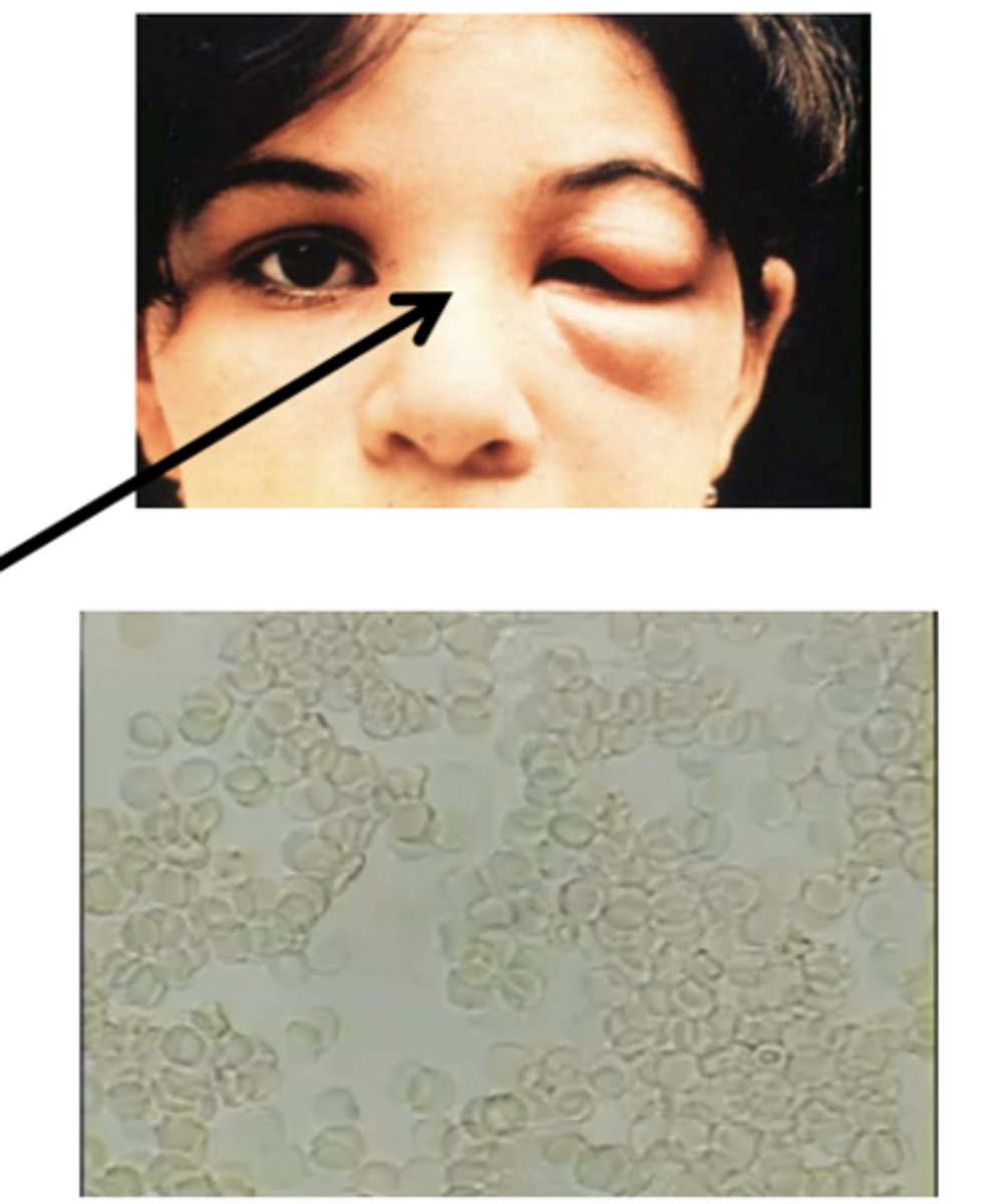 <p>What is it called when the Chagoma is on the eyelid?</p>