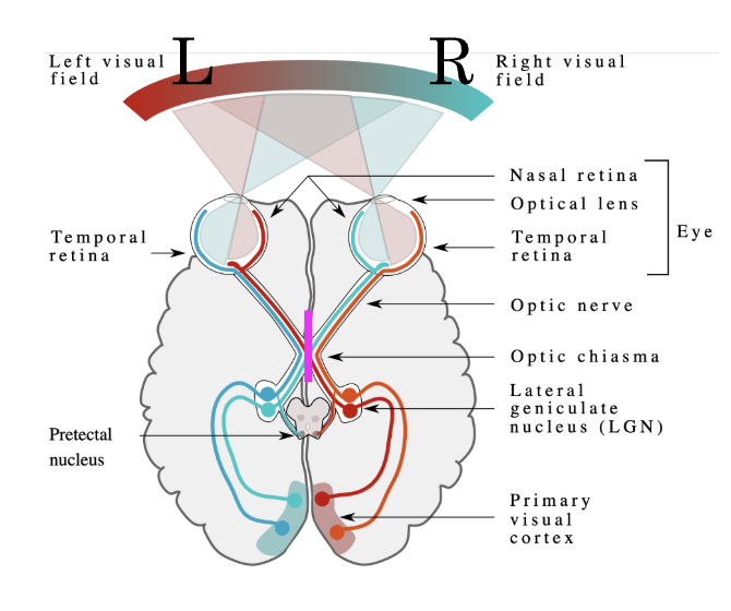 <p>What does the visual deficit (lesion) at the optic chiasma cause?</p>
