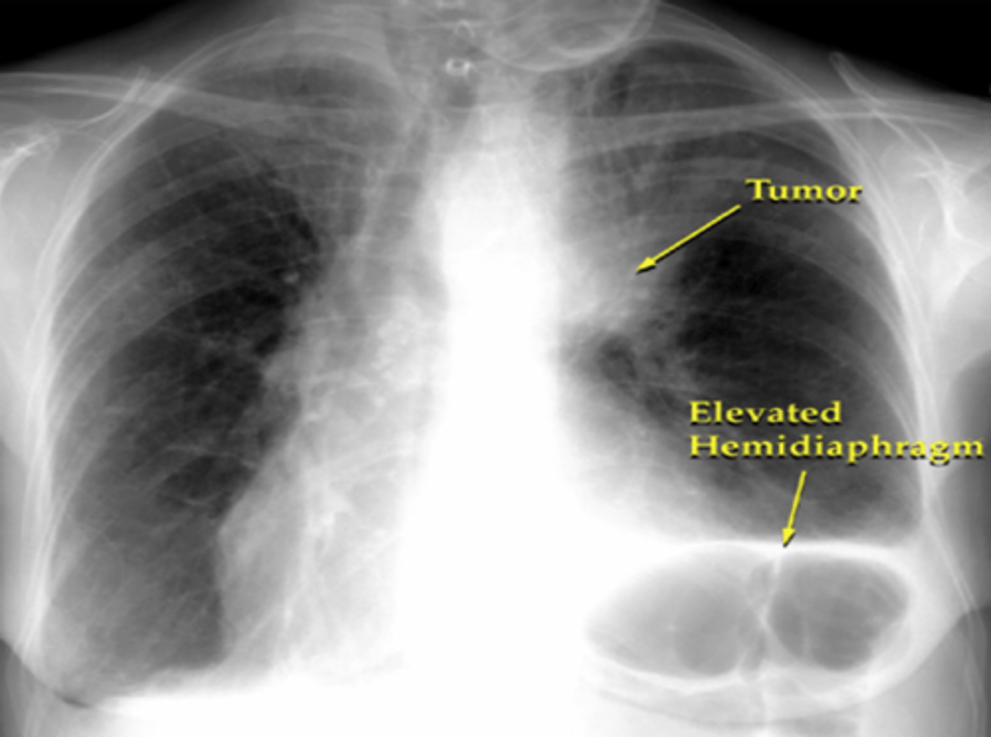 <p>2 stage system:<br>-<b>limited-stage disease</b> (30% of people; one hemithorax and regional lymph nodes involved)<br><br>-<b>extensive-stage disease</b> (<b>70% of people</b>; disease is beyond hemithorax and regional lymph node bounderies)<br><br><b>small cell has different type of staging because it is so aggressive compared to the other cancers; risk for early metastasis</b></p>