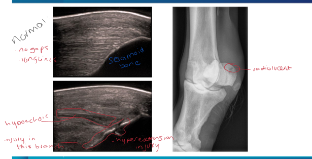 <p>How may suspensory branch desmitis/sesamoiditis appear on an ultrasound/radiograph</p>