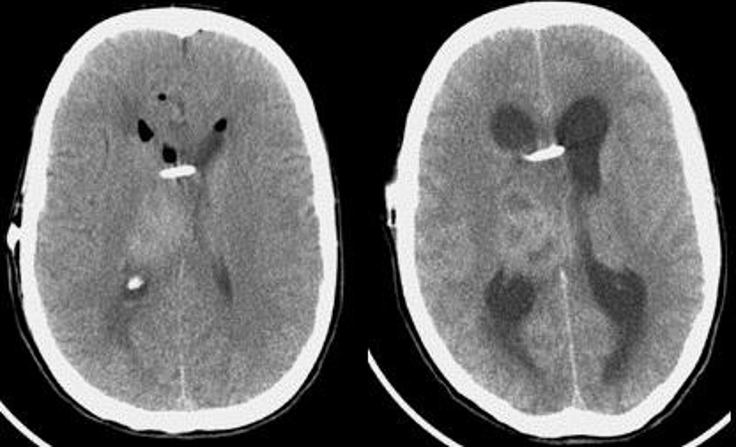 <p>inflammation of the brain tissue</p>