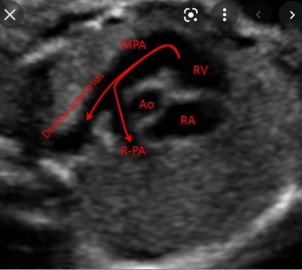 <p>What is RVOT?</p>