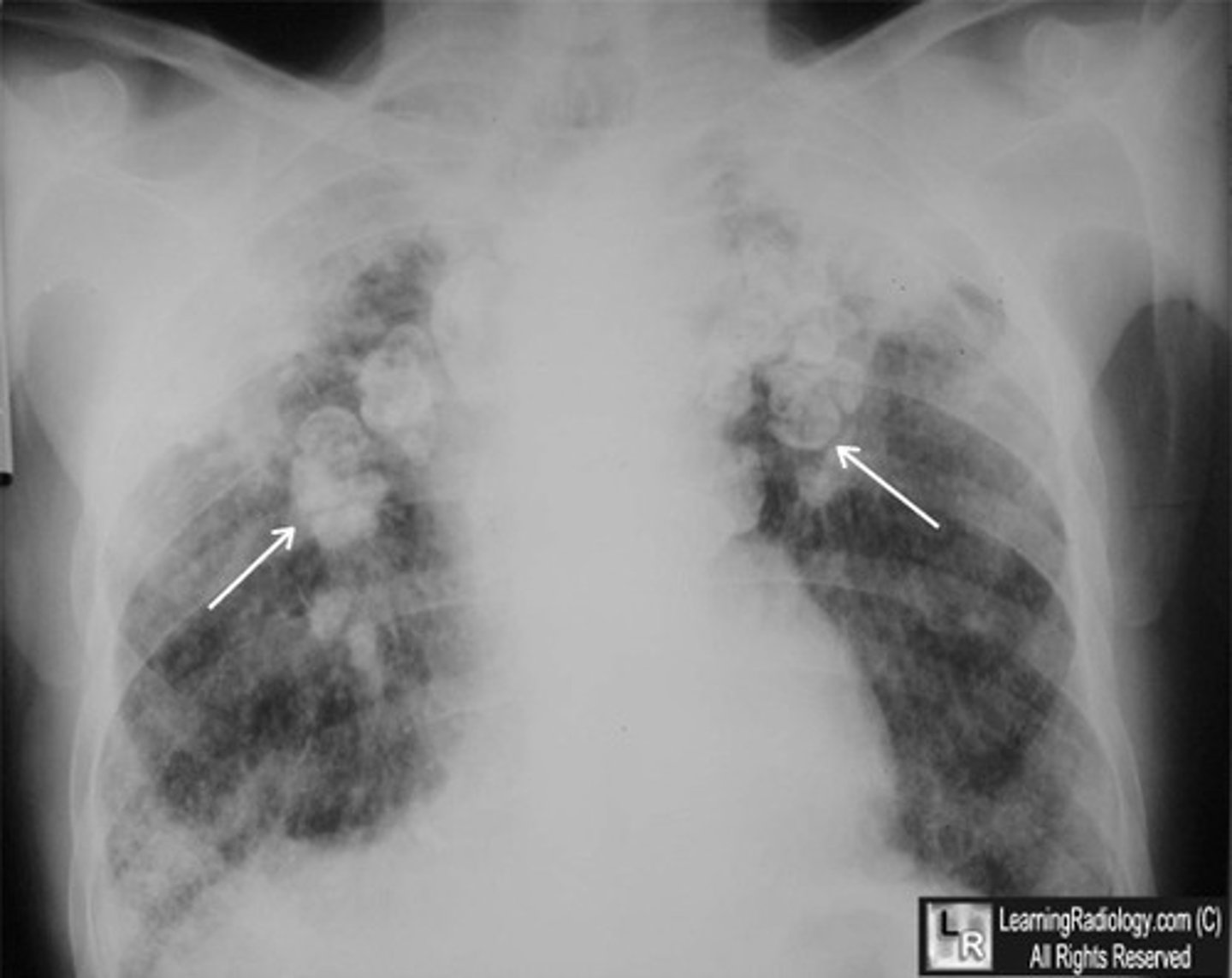 <p>CXR; shows progressive massive fibrosis &amp; "eggshell" calcifications (hilar lymph node calcification)</p>