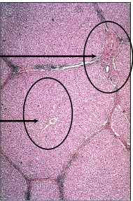 <ul><li><p>okołowrotne (pierwsza strefa zrazika)</p><ul><li><p>kwashiorkor, żywienie pozajelitowe, posocznica, wstrząs toksyczny</p></li></ul></li><li><p>okołocentralne (trzecia strefa zrazika)</p><ul><li><p>alkoholizm, otyłość, cukrzyca, sterydoterapia</p></li></ul></li></ul>
