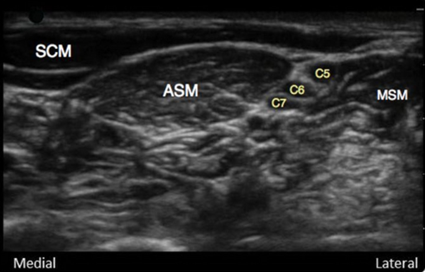<p>anterior scalene muscle (medial to nerve bundle)</p><p>middle scalene muscle (lateral to nerve bundle)</p><p>sternocleidomastoid (above ASM and nerve bundle)</p>