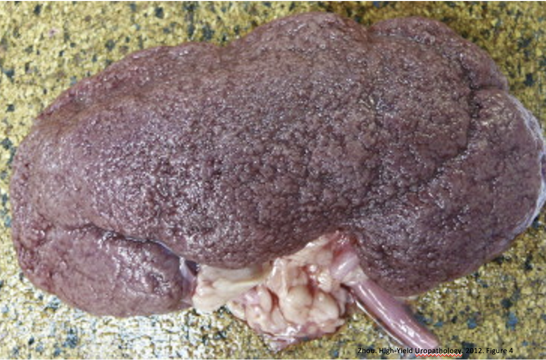 <p>What is the pathology shown here mostly associated with?</p>