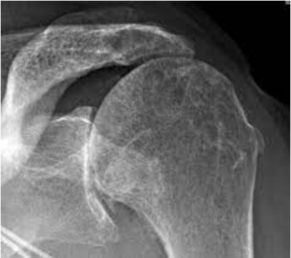 <p>Having an elevated humeral head can be indicative of an injury to what group of muscles?</p>