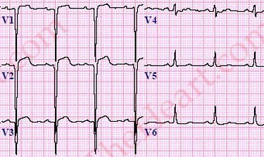 <p>Persistent coving ST elevation after a ACUTE MI (after a couple of weeks)</p>