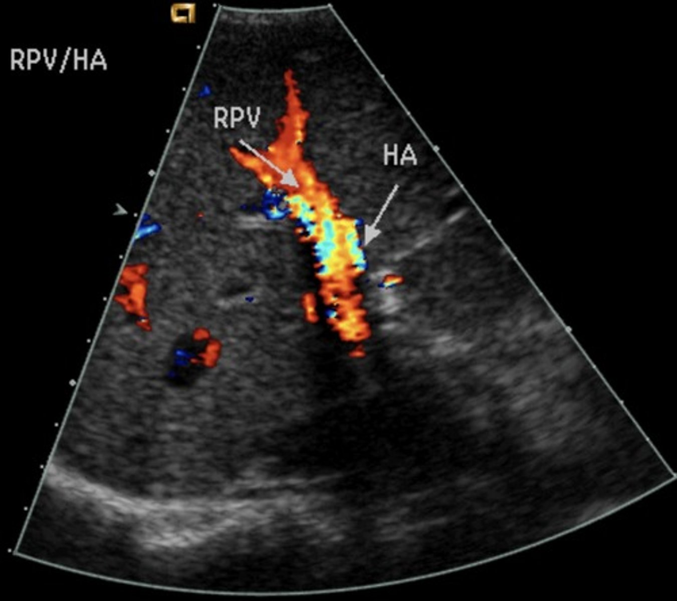 <p>Porta hepatis: red</p><p>Portal-Splenic confluence: red</p>