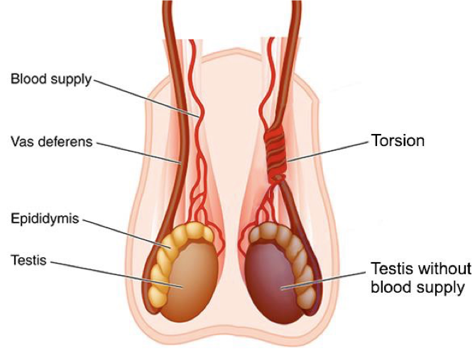 <p>Torsion of a testis</p>