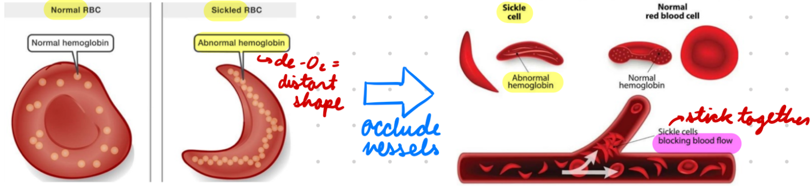 <p>Sickle Hb</p><p><span style="background-color: transparent;"><span>Cause sickle cell disease</span></span></p><p><span style="background-color: transparent;"><span>Subunits: α</span><sup><span>A</span></sup><sub><span>2</span></sub><span>β</span><sup><span>S</span></sup><sub><span>2</span></sub></span></p><ul><li><p><span style="background-color: transparent;"><span>2 normal alpha chains</span></span></p></li><li><p><span style="background-color: transparent;"><span>2 abnormal beta subunits</span></span></p></li></ul><p>O2 Binding Affinity: Lower than HbA</p><ul><li><p><span style="background-color: transparent;"><span>De-O2 form = Sickled rod shape = RBC distortion = RBC stick together</span></span></p></li><li><p><span style="background-color: transparent;"><span>Occlude blood vessels</span></span></p></li></ul><p></p>