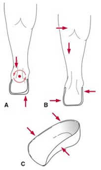 <p>what is the action of the UCBL Foot Orthosis – Subtalar joint in A?</p>