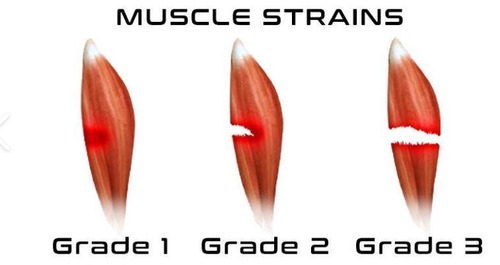 <p>Mild strain with local pain and little bruising, little to no loss of strength or motion.</p>