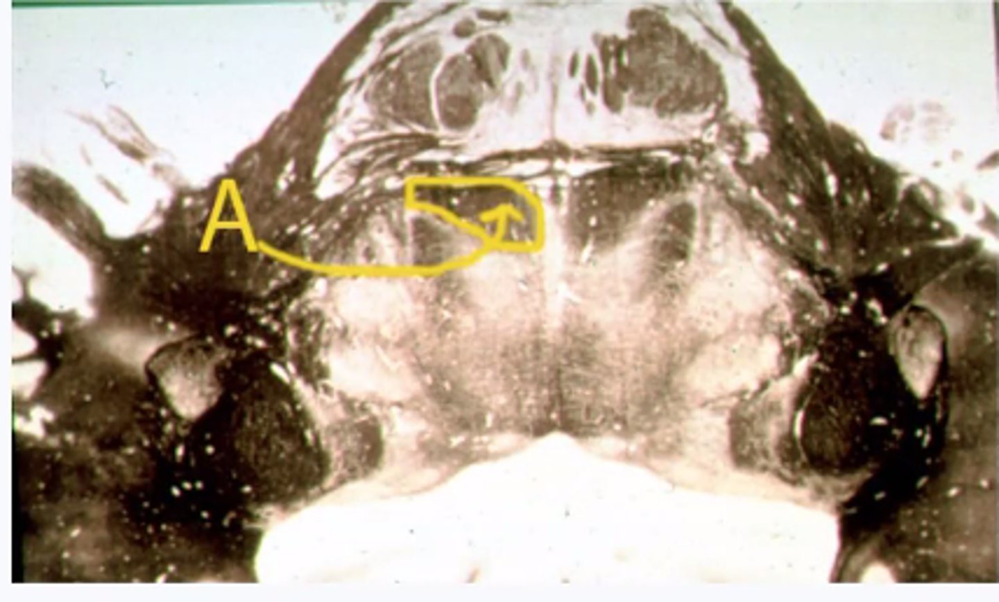 <p>Describe the signs/symptoms if structure "A" is lesioned <br><br>A. contralateral loss of vibratory sense from the body <br><br>B. contralateral spastic paresis to the body<br><br>C. Ipsilateral loss of pain &amp; temp from the body <br><br>D. contralateral flaccid paralysis to the body <br><br>E. ipsilateral loss of vibratory sense from the body</p>