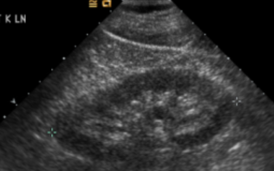 <p>is this a short or long axis of the kidney</p>