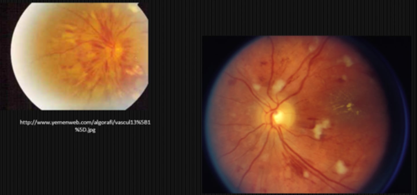 <p>flame-shaped hemorrhages near the ONH with CWS</p>