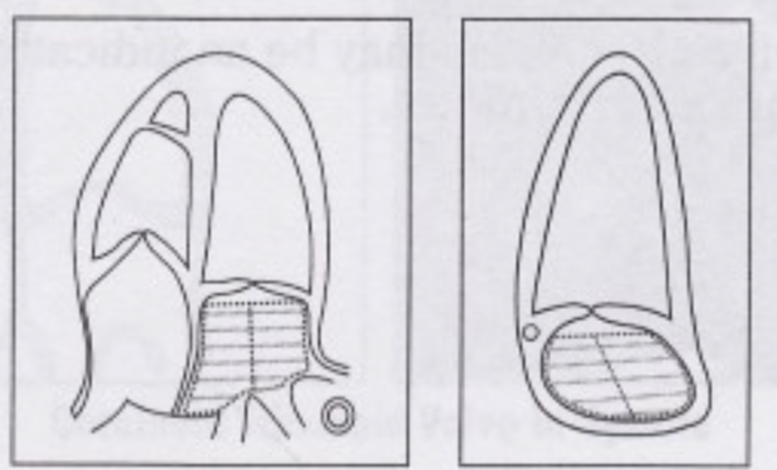 <p> disk summation technique:  adding the volume of a stack of cylinders of height and area calculated by orthogonal minor and major transverse axes, D1 and D2</p>