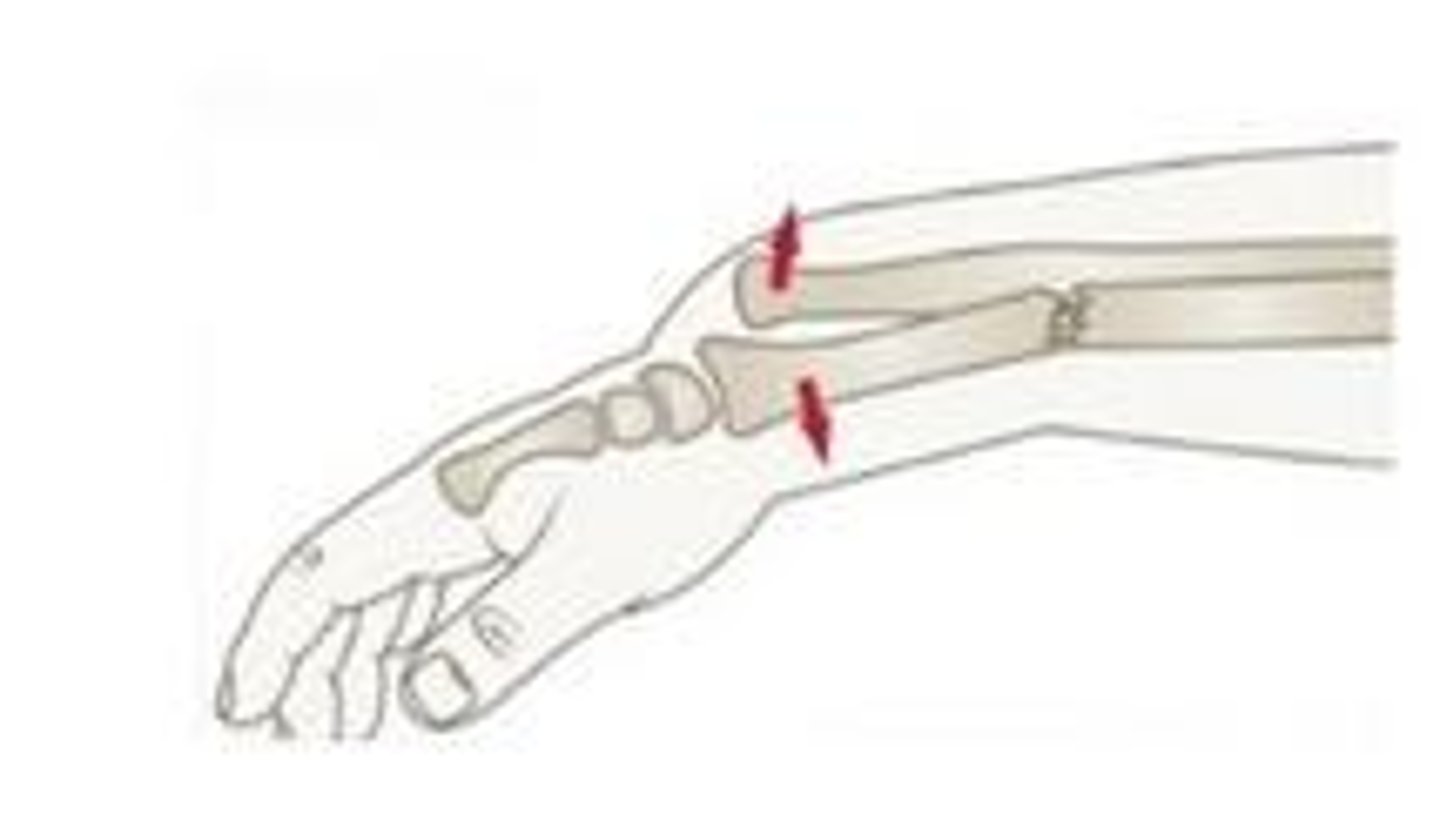 <p>Wrist pain in the snuffbox, minimal swelling, and pain with thumb movement</p>