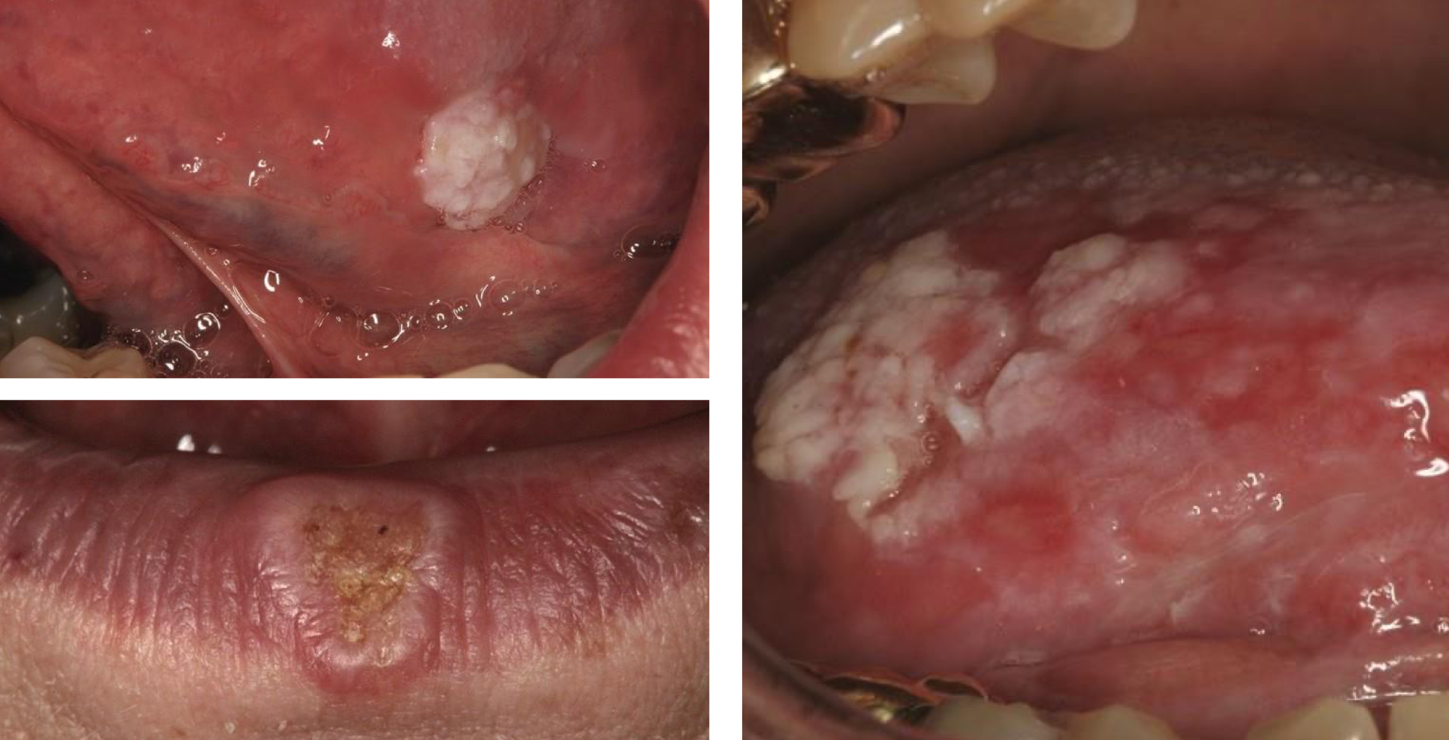 <p>which neoplastic white lesion:</p>