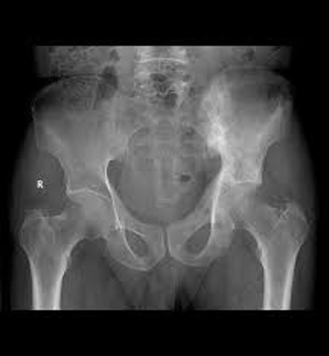 <p>excessive and haphazard bone deposit and resorption; bone made fast and poorly; very high ratio of spongy to compact bone and reduced mineralization; usually in spine, pelvis, femur, and skull; rarely occurs before age 40; cause unknown - possibly viral</p>